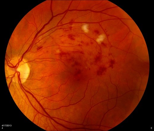 Branch Retinal Vein Occlusion